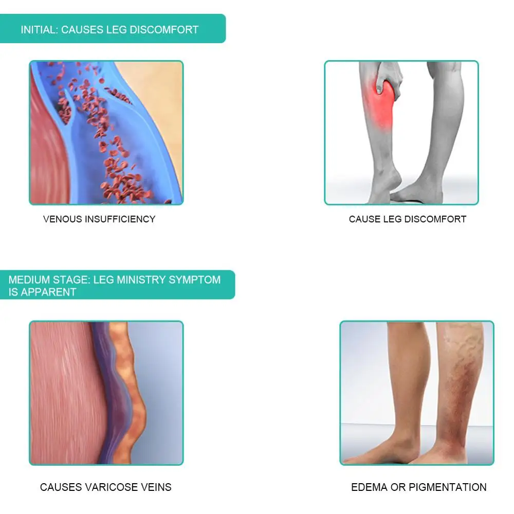 1 çift tıbbi varis çorabı 30-4 - Compression Sleeve Calf incelemesi ve fiyatı